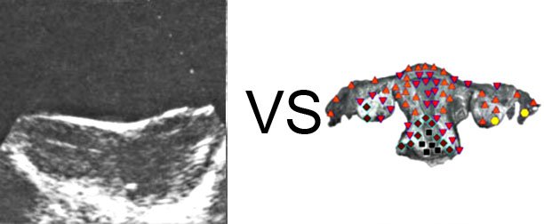 VECTOR NLS vs. Ultrasound Study (15)